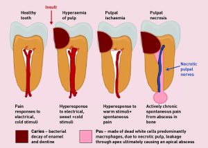 Is tooth nerve pain serious?