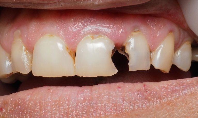 How do you fix badly decayed teeth?