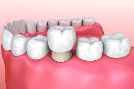 dentist repair a tooth