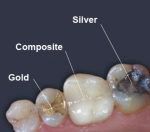 How much does it cost for a tooth filling?