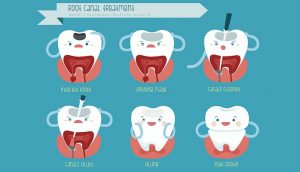 painful are fillings after