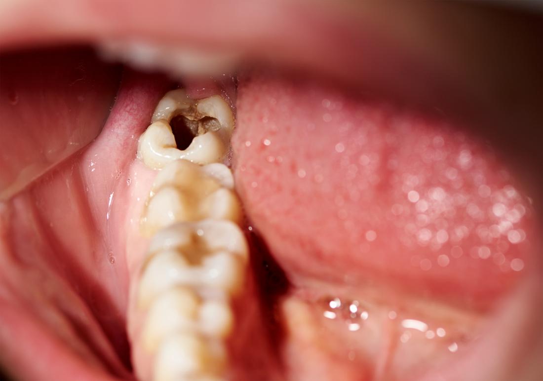 What are the symptoms of tooth nerve damage?