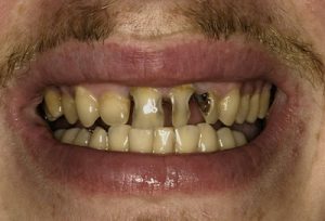 veneers on rotten teeth