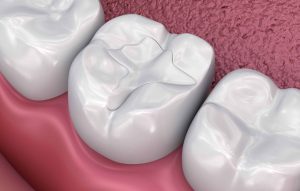 How long do fillings last in teeth?