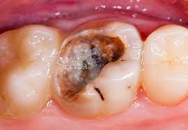 Can a big hole in a tooth be filled?