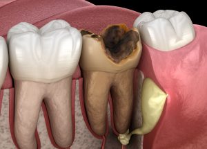 What causes tooth nerve to go bad?