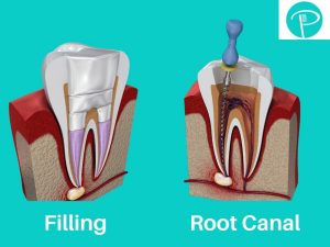 Does tooth nerve pain go away?