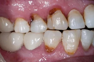 Can you put veneers on rotten teeth?