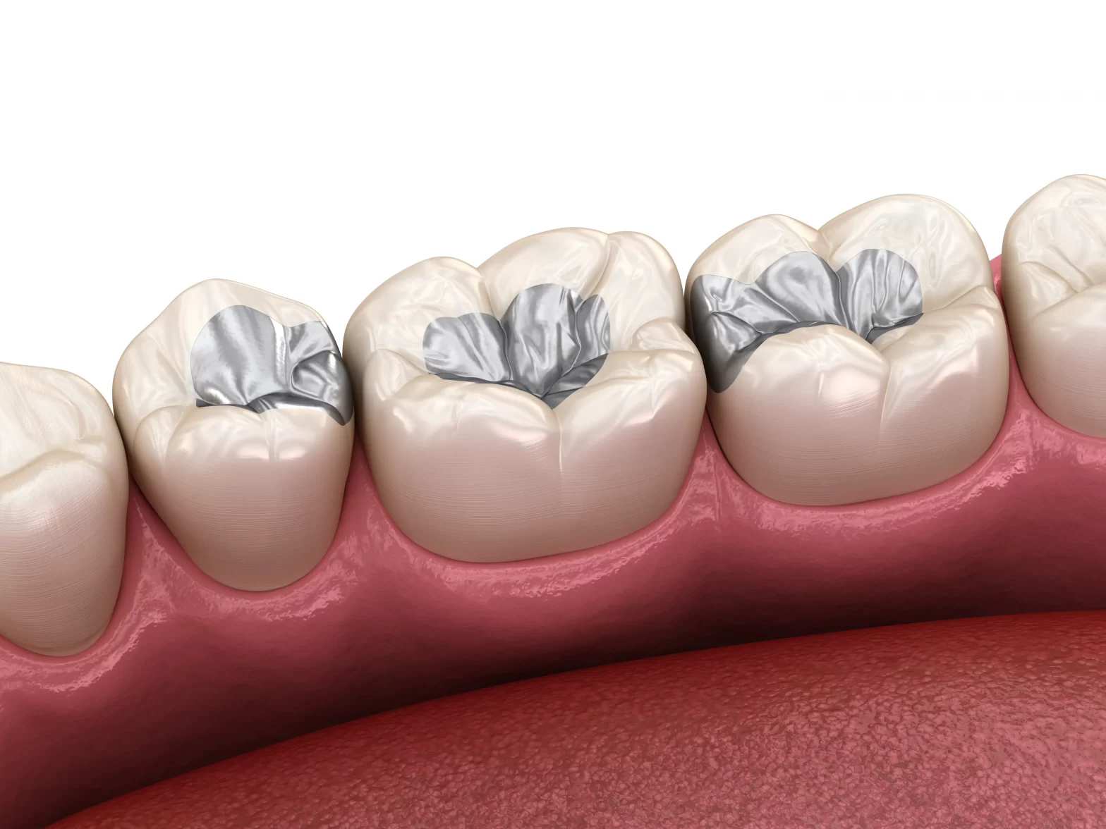 How long do fillings last in teeth?