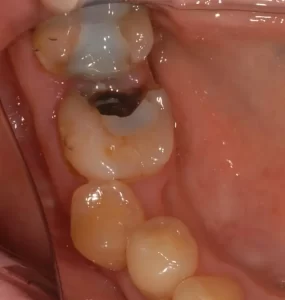 hole in a tooth be filled