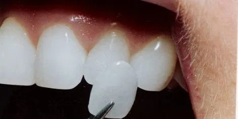 Can you put veneers on rotten teeth?