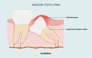 nerve pain in your teeth