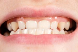 Is teeth grinding a serious problem?