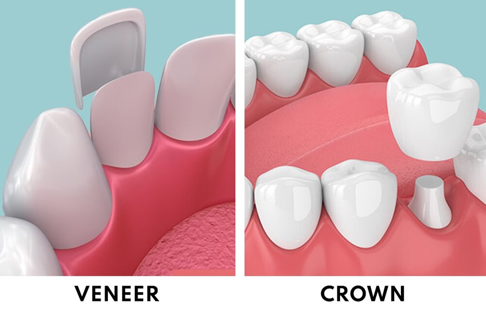 The Difference Between Dental Crowns and Veneers Explained