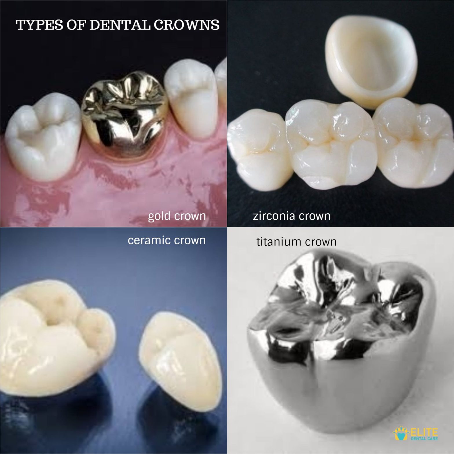 Tooth Crowns 101: Types, Benefits, and What to Expect