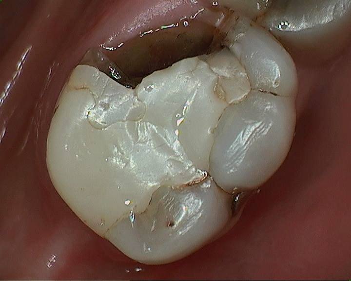 When Do You Really Need a Tooth Crown?