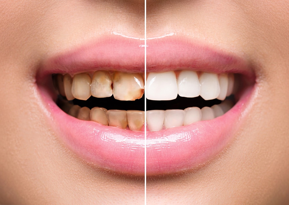 How to Choose the Right Cosmetic Dental Treatment for You