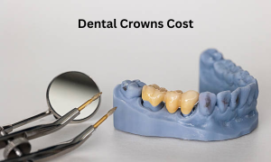 Cost of Dental Bridges: What Factors Affect the Price?