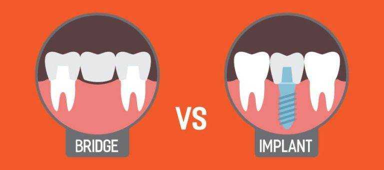 Dental Bridges vs. Implants: Which Tooth Replacement Option Is Right for You?