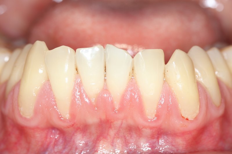 How to Regrow Receding Gums: Fact vs. Myth