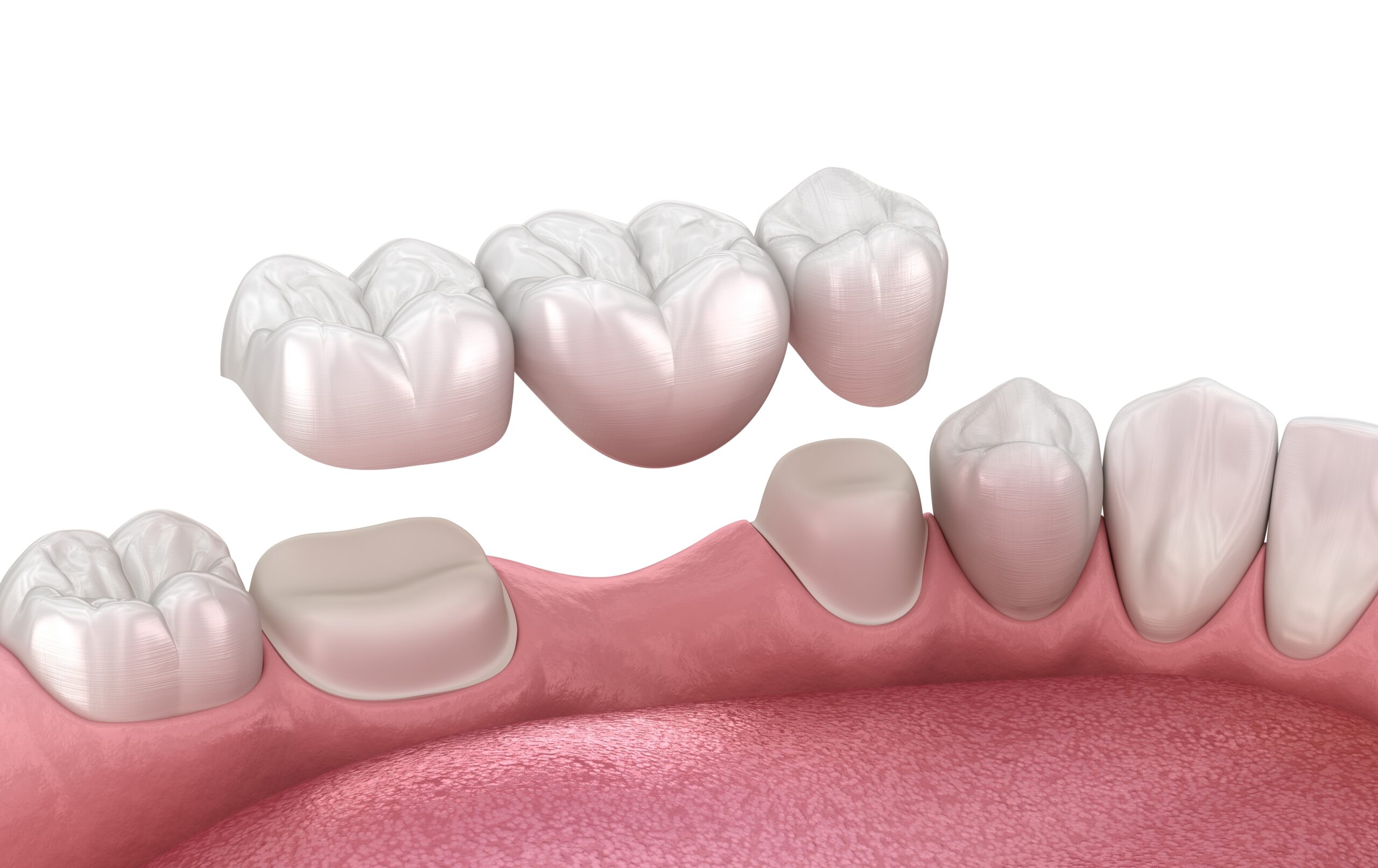 Foods to Avoid with a Dental Bridge