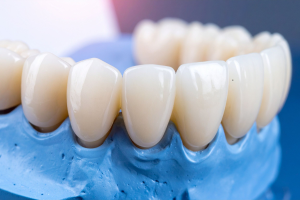 How Dental Bridges Restore Your Smile and Confidence