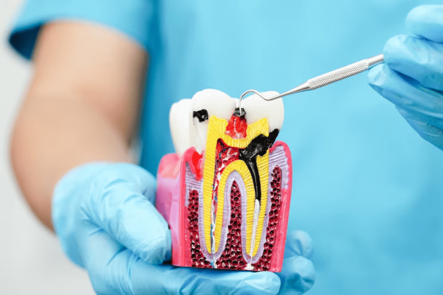 How Root Canal Treatment Saves Your Natural Tooth