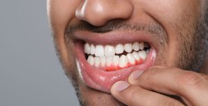 Dental Professionals Reveal the Best Ways to Treat Gum Problems