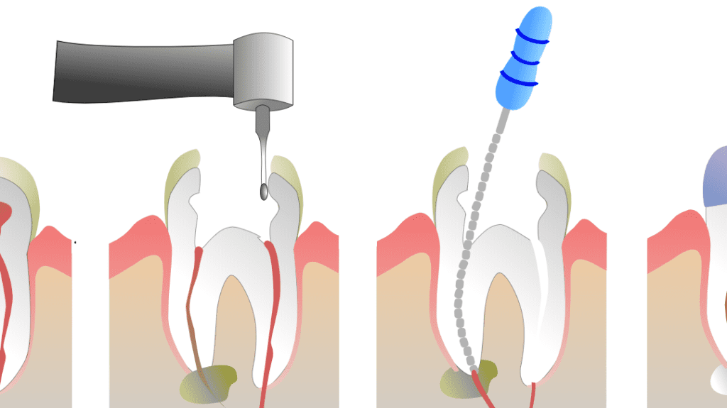 Step-by-Step: What Happens During a Root Canal Procedure?
