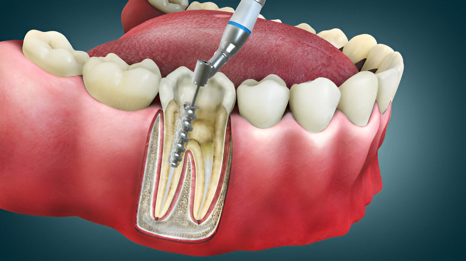What Is Root Canal Therapy? A Complete Beginner’s Guide