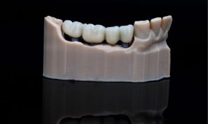 Who Is a Good Candidate for a Dental Bridge? Who Is a Good Candidate for a Dental Bridge?