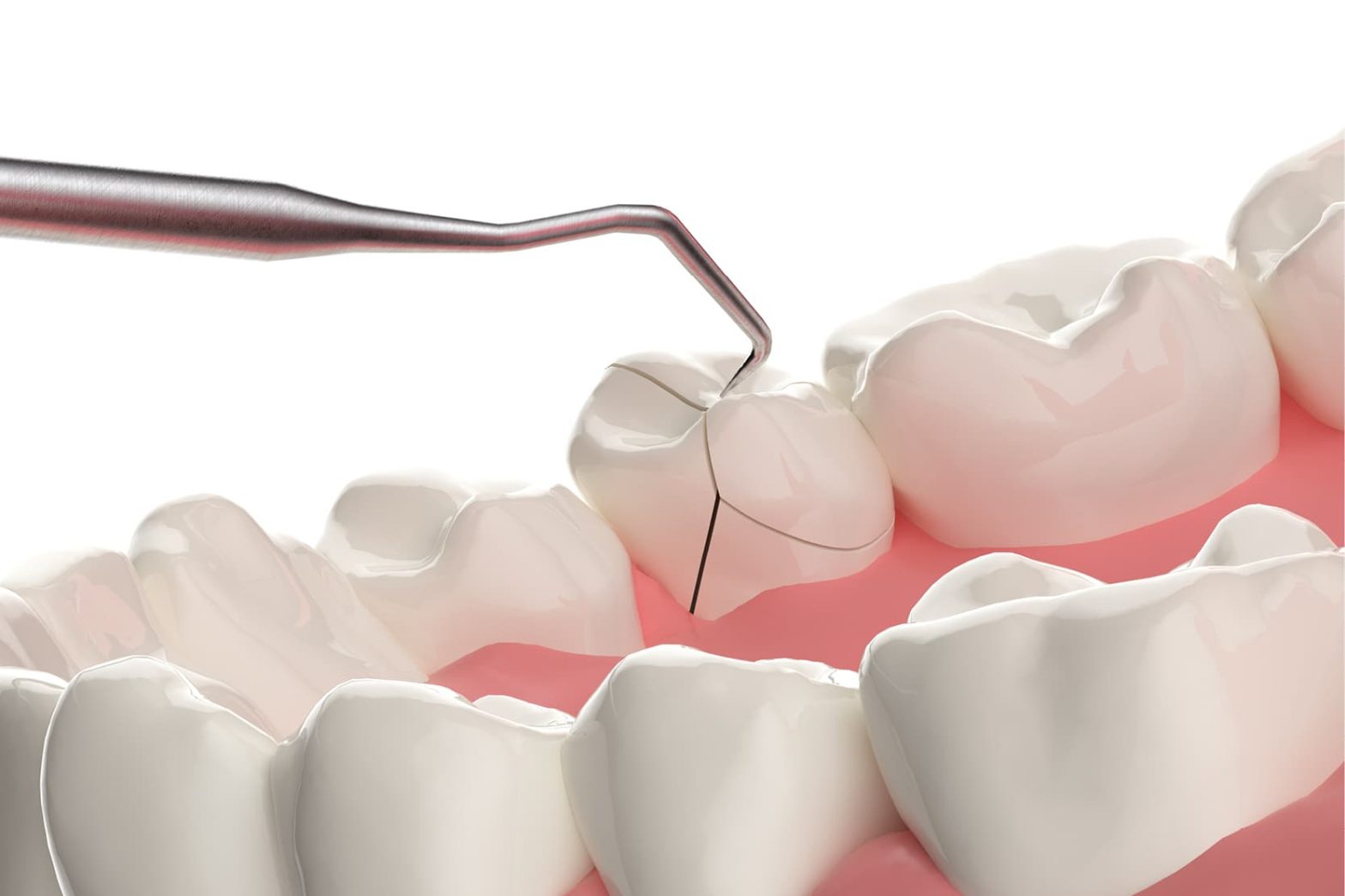 Cracked Tooth Syndrome: Symptoms, Causes, and Treatment