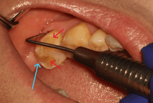 How Endodontists Save Teeth That Would Otherwise Be Extracted How Endodontists Save Teeth That Would Otherwise Be Extracted