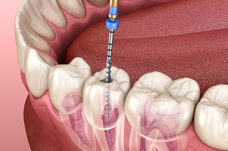 How Endodontists Save Teeth That Would Otherwise Be Extracted