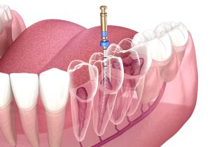 How Long Does a Root Canal Last?