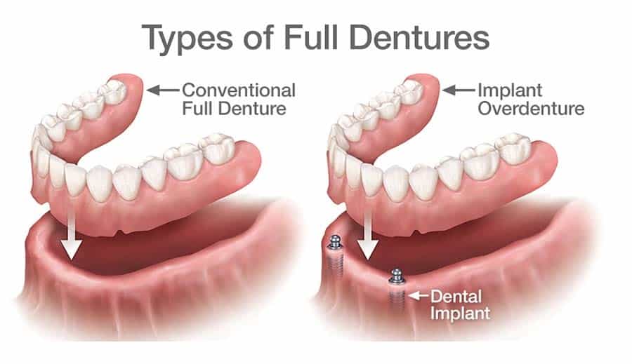 Modern Dentures vs. Traditional Dentures: What’s the Difference?