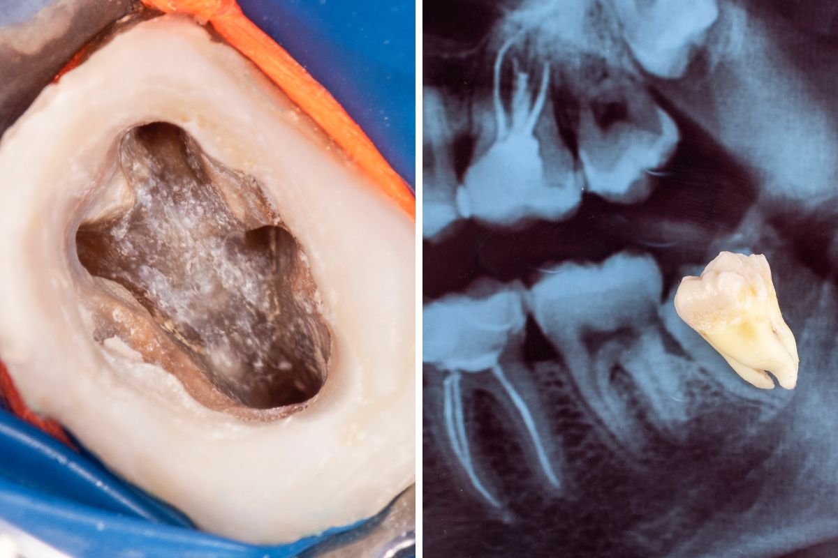 Root Canal vs Tooth Extraction: Which Is Better?