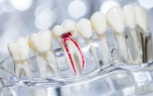 What Happens If You Ignore an Infected Tooth?