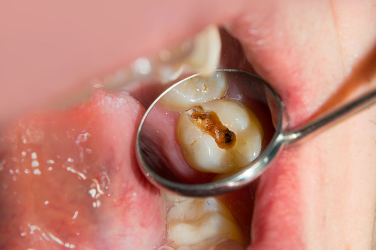 What Happens If You Ignore an Infected Tooth?