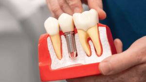 10 Common Myths About Dental Implants—Debunked