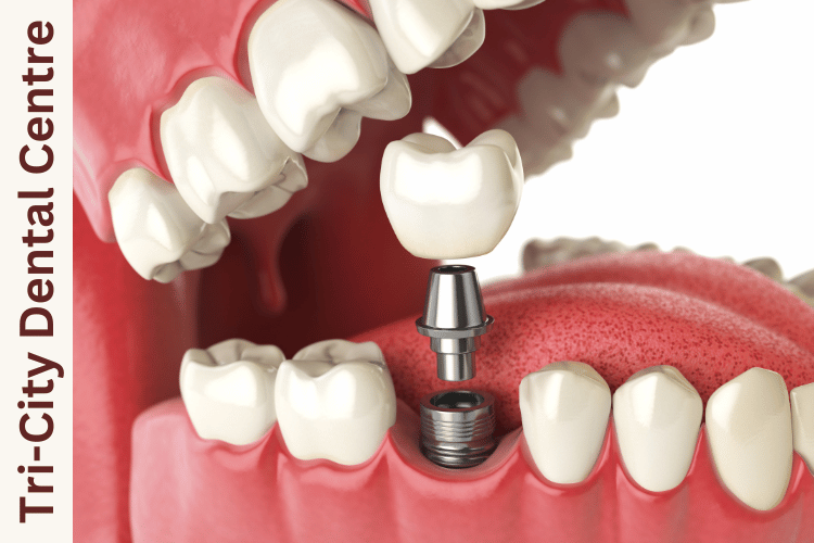 10 Common Myths About Dental Implants—Debunked