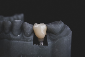 Are Dental Implants Only for Older Adults? Think Again Are Dental Implants Only for Older Adults? Think Again