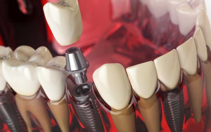 Are Dental Implants Only for Older Adults? Think Again