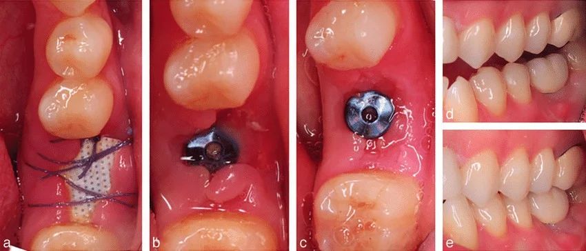 Dental Implant Recovery Timeline: What Happens Day by Day