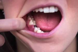 Do Dental Implants Hurt? What the Procedure Really Feels Like