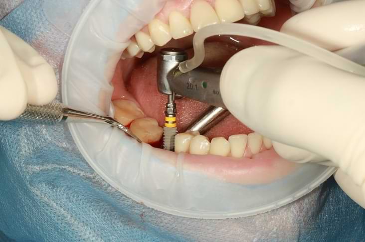 Do Dental Implants Hurt? What the Procedure Really Feels Like