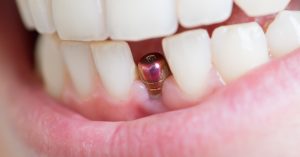 Pain vs Gain: Is Getting Dental Implants Really That Bad?