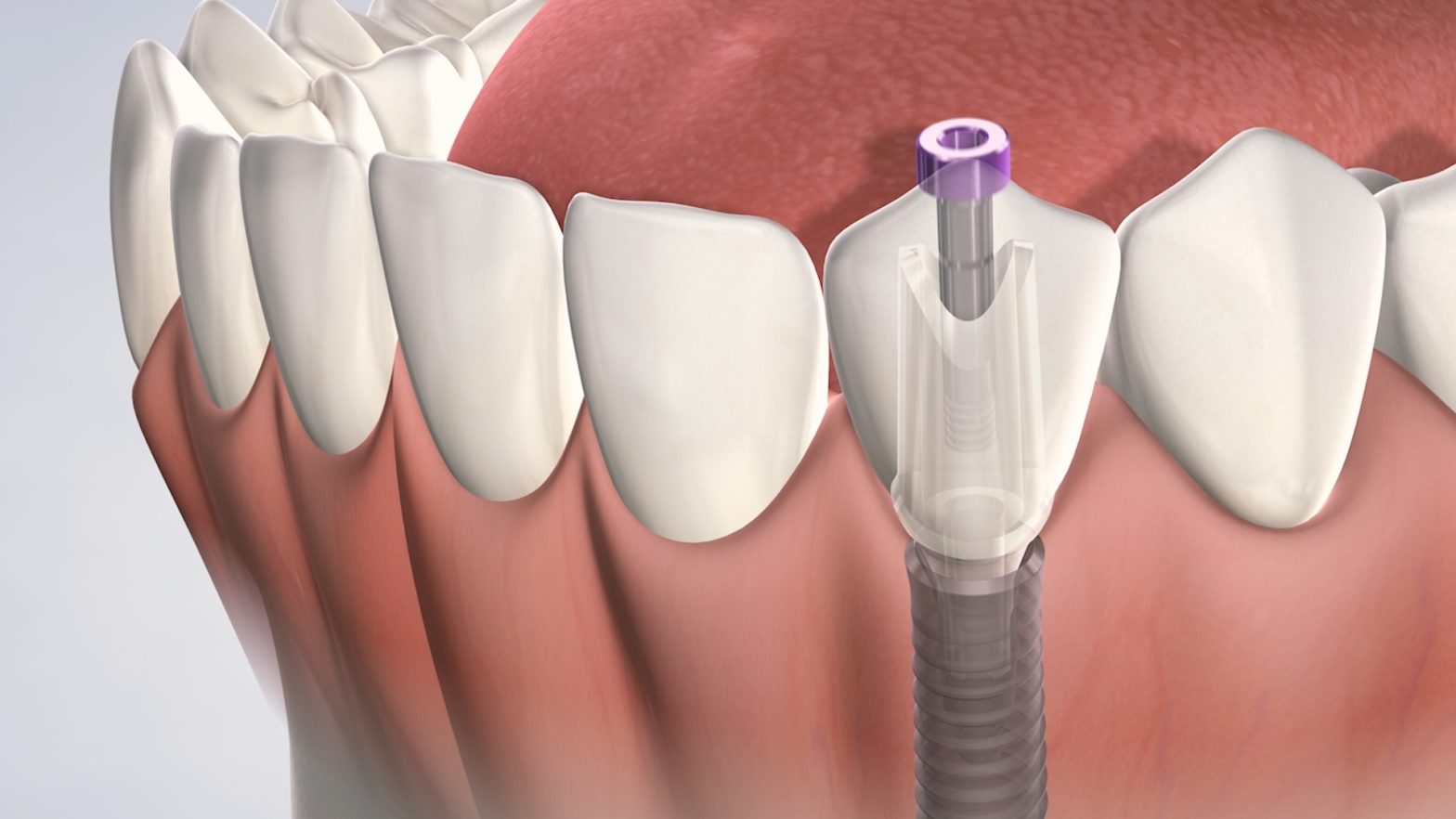 Pain vs Gain: Is Getting Dental Implants Really That Bad?