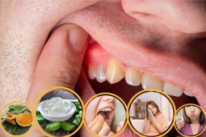 Prevent Gum Disease Naturally