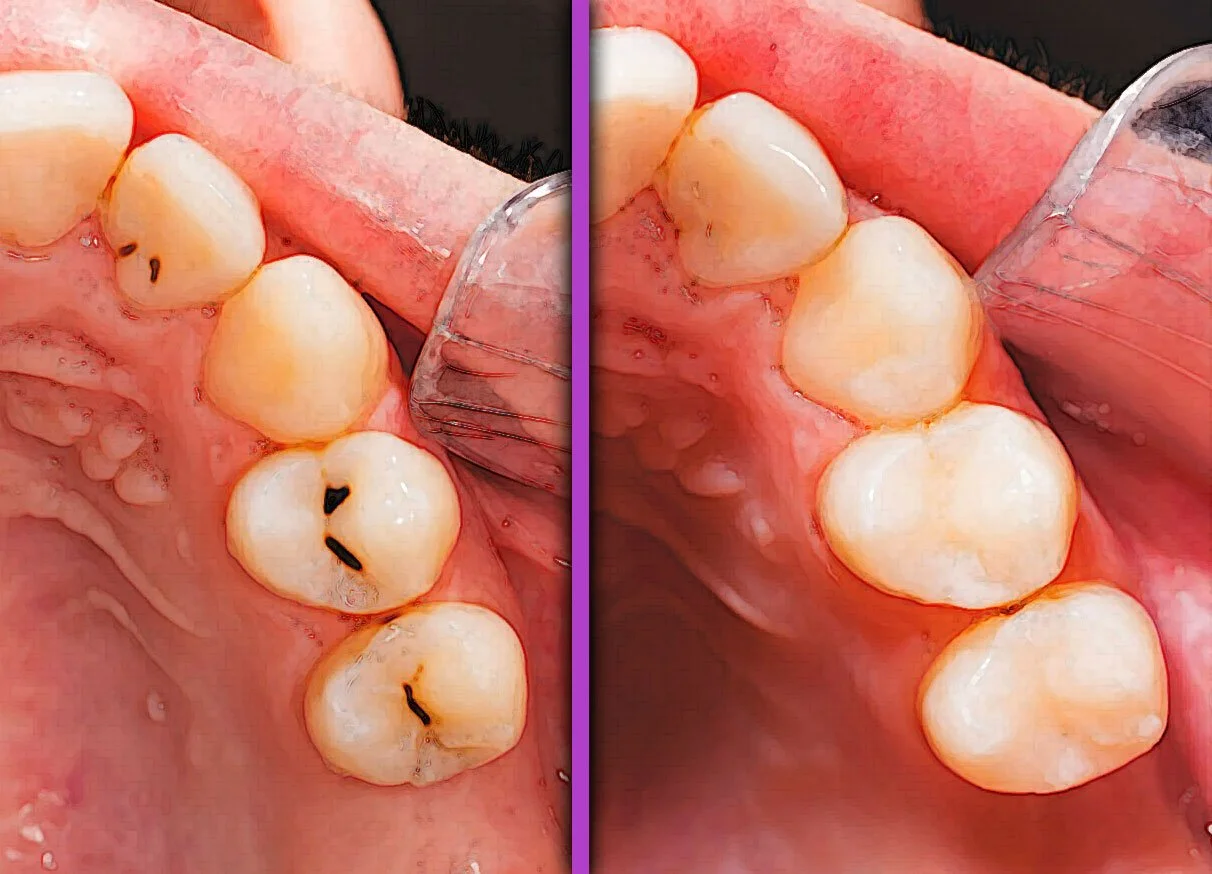 Sealants: Small Steps, Big Protection